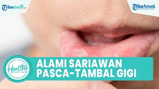 Efek Samping Pasca-Tambal Gigi pada Rongga Mulut, Satu di Antaranya Sariawan