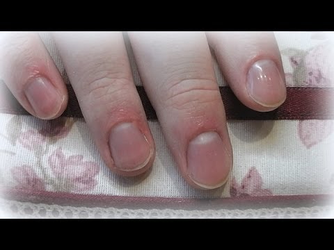 Klotrimosolowaja die Salbe bei gribke des Nagels Die Tropfen die Salbe von gribka auf den Nägeln auf den Beinen der Preis