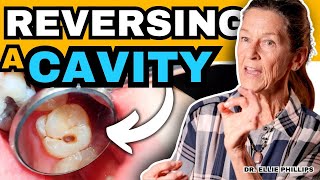 How To Reverse a Cavity at Home | Cure Tooth Decay