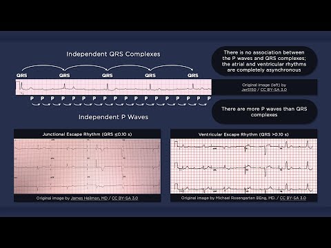 Third Degree Atrioventricular Block ECG