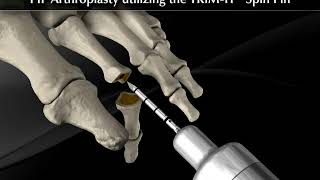 Operación Dedo en Garra| Cirugía Podológica| Centro Clínico Quirúrgico en Vigo