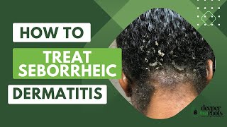 How to treat Seborrheic Dermatitis @deeperthanrootsscalpcare