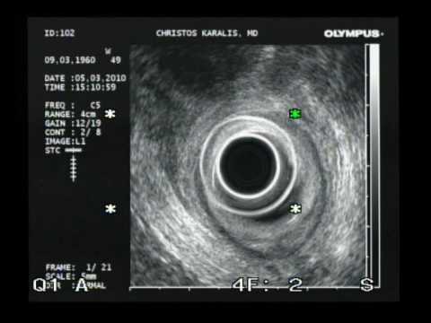 Endoscopic Ultrasoud Of Anorectum