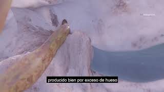 Intervención de una estenosis de canal lumbar (Animación 3D) - Clínica Dr. Mosqueira