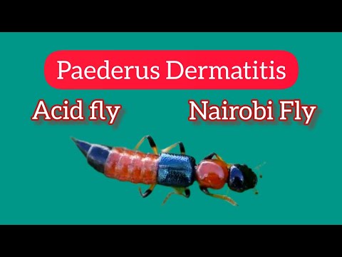 Paederus Dermatitis/ Nairobi fly/ Cause, Symptoms, Treatment of Acid Fly infection