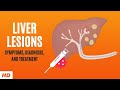 Liver Lesions Symptoms Diagnosis And Treatment