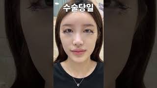 뒤트임 성형 시술