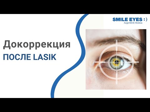 Докоррекция после LASIK - возможности и как проходит?