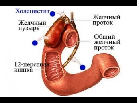 Спондилирующий шейный остеохондроз Кинезотерапия от боли в спине кузнецова гершбург