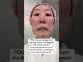 How to Shrink a Cystic Pimple FAST! Dermatologist’s Emergency Fix 🚨