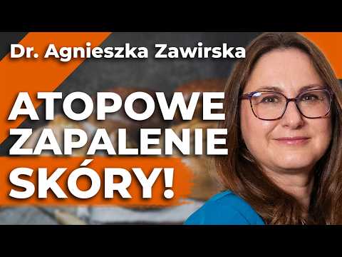 ATOPOWE ZAPALENIE SKÓRY – AZS – MOŻNA LECZYĆ AZS? – Dr. Agnieszka Zawirska