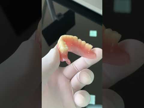 We achieved the best possible adhesion of a lower complete denture in the mouth 😃🎉🎉