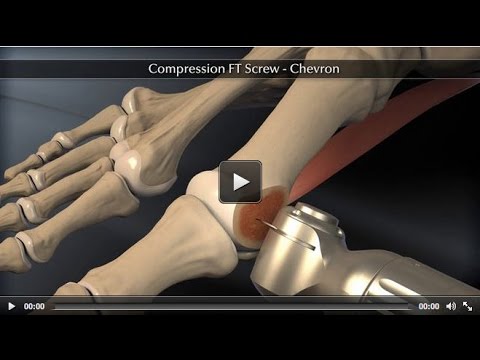 Headless Compression Screw – Chevron Animation