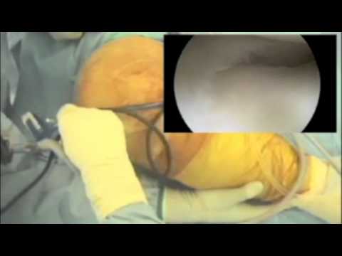 Meniscal Repair Arthroscopically - Knee
