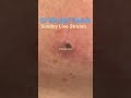 Massive Blackhead Extraction Blackheads Skincare Dr Khaled Sadek
