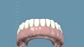 Overdentatures barra e clip su 4 impianti