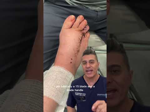 Removing Sutures from Foot ⚠️ Trigger Warning