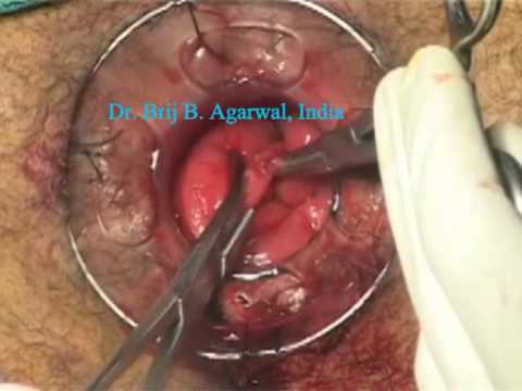 Stapled Transanal Rectal Resection  For Obstructed Defecation Syndrome 