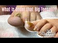 👣 Take Care of Your Toenail Pain at Home Online Ingrown Pedicure Lesson 👣 👣 Take Care of Your Toenail Pain at Home Online Ingrown Pedicure Lesson 👣