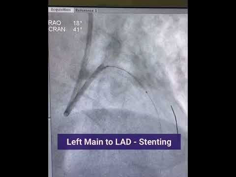 Left Main Angioplasty #leftmainstenting #angioplasty #radialistas #provisionalstenting