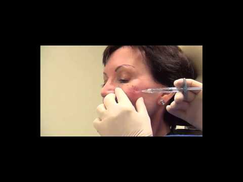 Suzanne’s Voluma Treatment