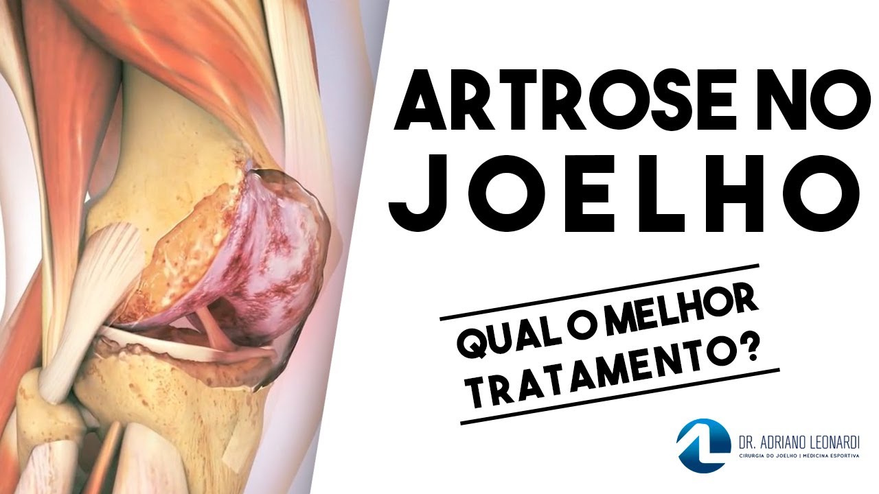 Cirurgia para ARTROSE NO JOELHO