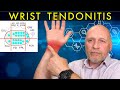 Is Your Wrist Pain A Tendonitis All About Diagnosis Treatment And Recovery