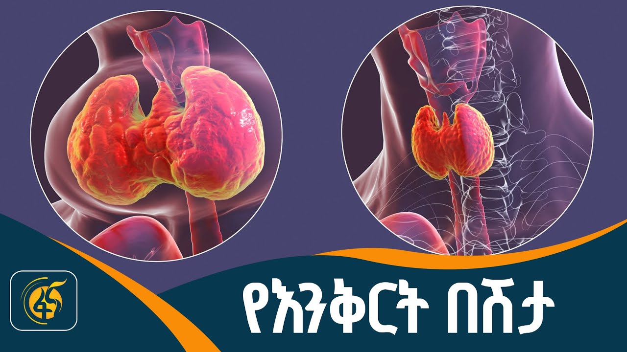 የእንቅርት ህመም እንዴት ይከሰታል?