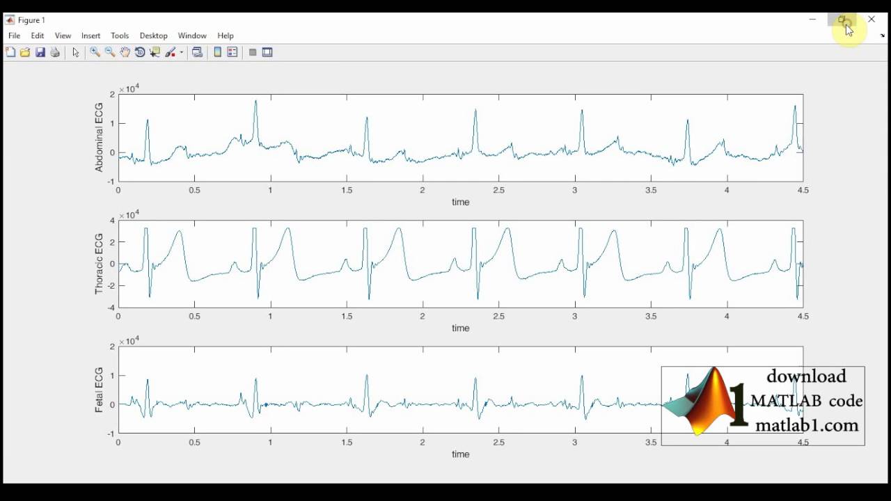 MATLAB Code of fetal ECG extraction using wavelet analysis