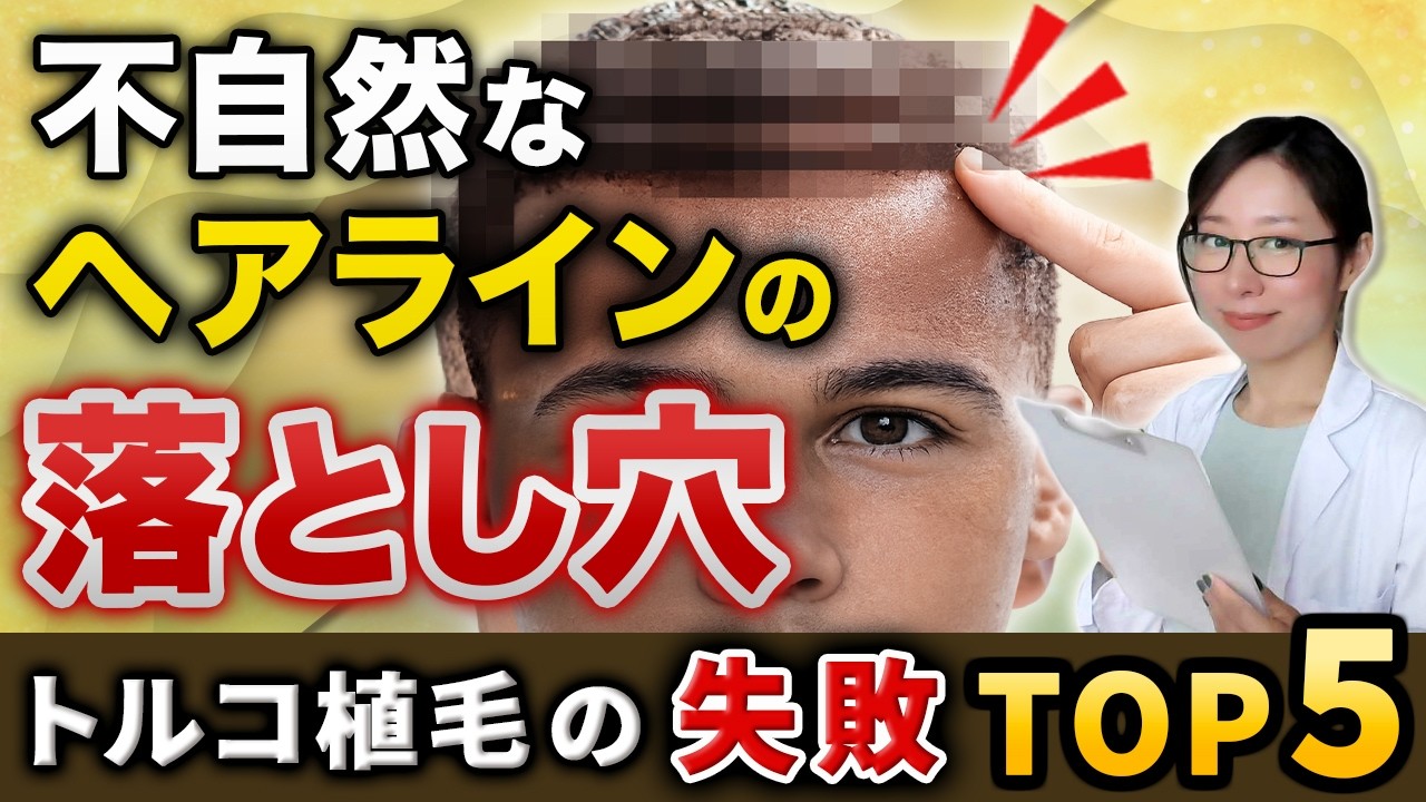 不自然なヘアラインの落とし穴｜トルコ植毛で失敗しないための4つのチェックポイント