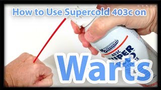 How to Use Supercold 403c Freeze Spray on Warts, Skin Tags, Moles or Freckles