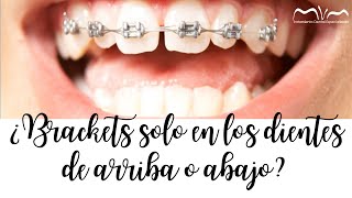 😱  Ortodoncia con pocos brackets! Es posible 😱
