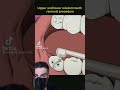 Wisdom Tooth Removal - Animated