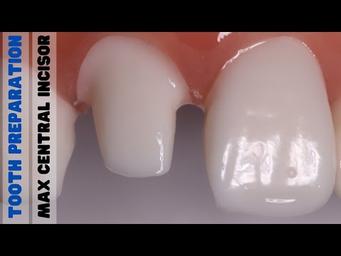 Tooth Preparation For A Crown - Maxillary Central Incisor