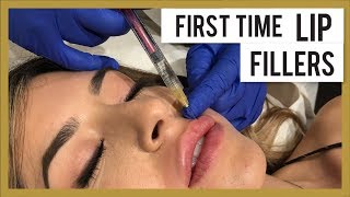 First Time Getting Lip Fillers (with Before and Afters)