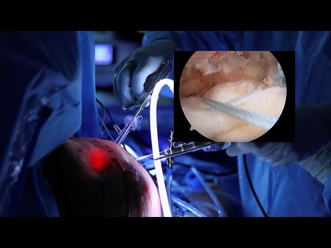 Rotator Cuff Repair Surgery