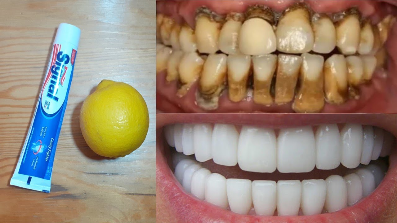 Natural mixture for yellow teeth whitening at home in one day without a dentist, a proven method
