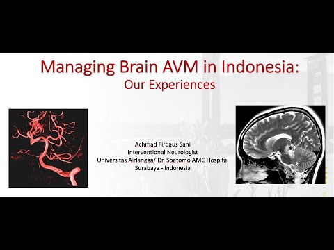 Embolisasi Brain AVM di Indonesia
