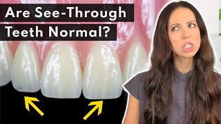 Why Are My Teeth TRANSLUCENT & How to FIX It 🦷
