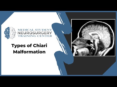 Types of Chiari Malformation