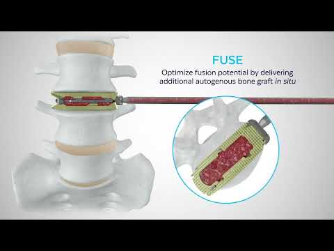 Globus Medical: RISE® L Expandable Lateral Interbody Fusion Device