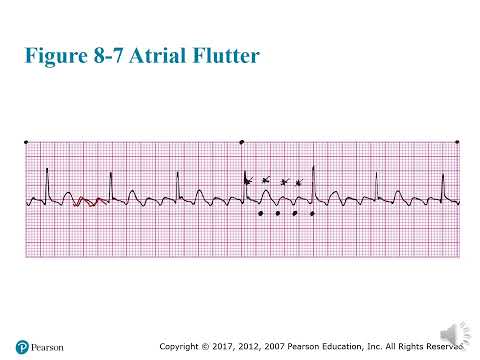 Chapter 8 Atrial Flutter, Atrial Fibrillation, and SVT PowerPoint Lecture