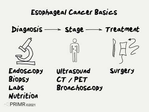 Doctor Explains Esophageal Cancer Basics