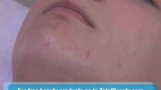 How to Extract a Blackhead from Your Skin Properly