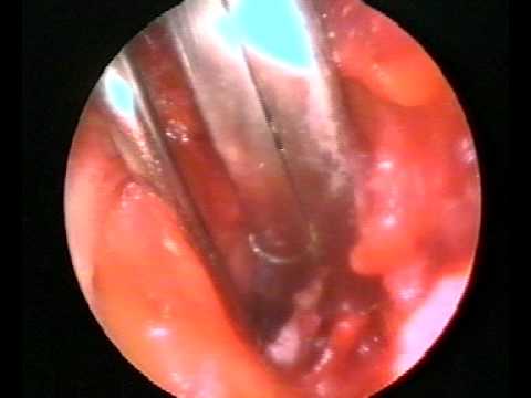 Su un cuscino si dovrebbe dormire con osteocondrosi Osteocondrosi dei sintomi della colonna lombare e il trattamento