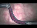 Deep Vein Thrombosis Treatment With Trellis Procedure NYC Surgical Associates