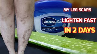 HOW MY LEG SCARS LIGHTEN FAST IN 2 DAYS SCAR,MOSQUITO, BITES ON LEGS WITH ALOE VERA.
