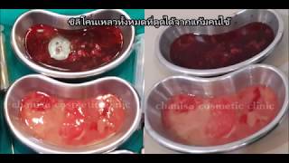 ดูดซิลิโคนเหลวที่ใกล้อักเสบบริเวณแก้ม