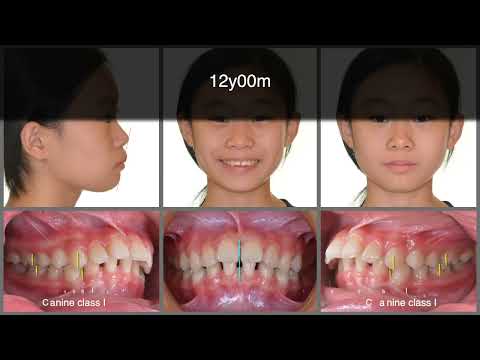 Treatment of Excessive Overjet with Congenital Missing Teeth｜【Chris Chang Ortho】CC631