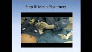 SAGES Pearls Session: Laparoscopic Inguinal Hernia Repair Introduction - Technique Video